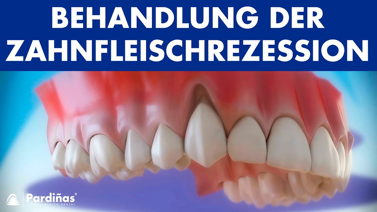 Zahnfleischrückgang – Behandlung der Zahnfleischrezession ©
