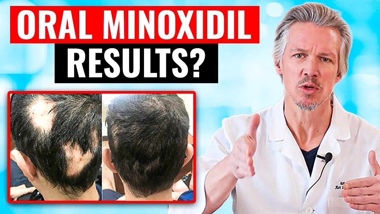 20,000 PEOPLE TOOK ORAL MINOXIDIL AND THIS HAPPENED