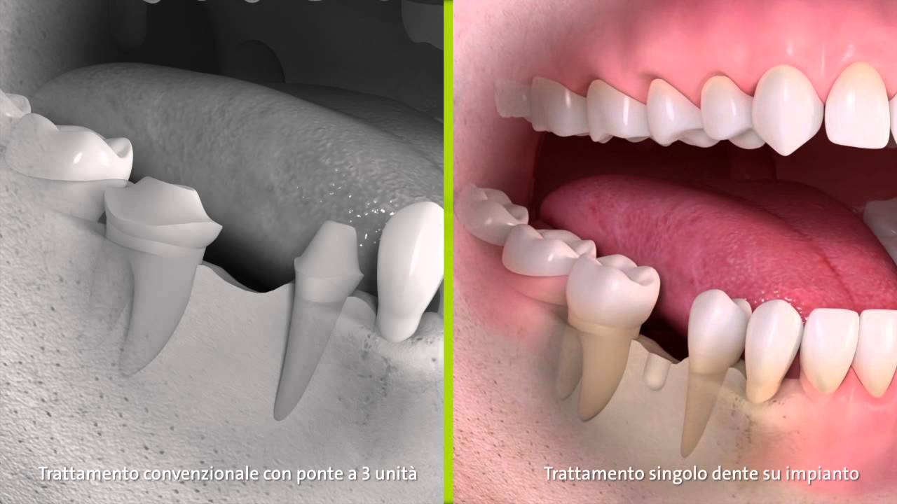 Straumann - Trattamento convenzionale con ponte a 3 unit&agrave; e trattamento singolo dente su impianto