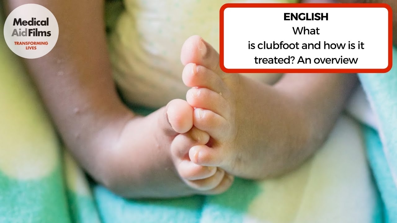 What is clubfoot and how is it treated?  An overview
