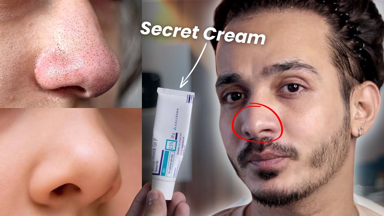 OMG! This Cream Erases Blackheads & Whiteheads Like Magic! 😱