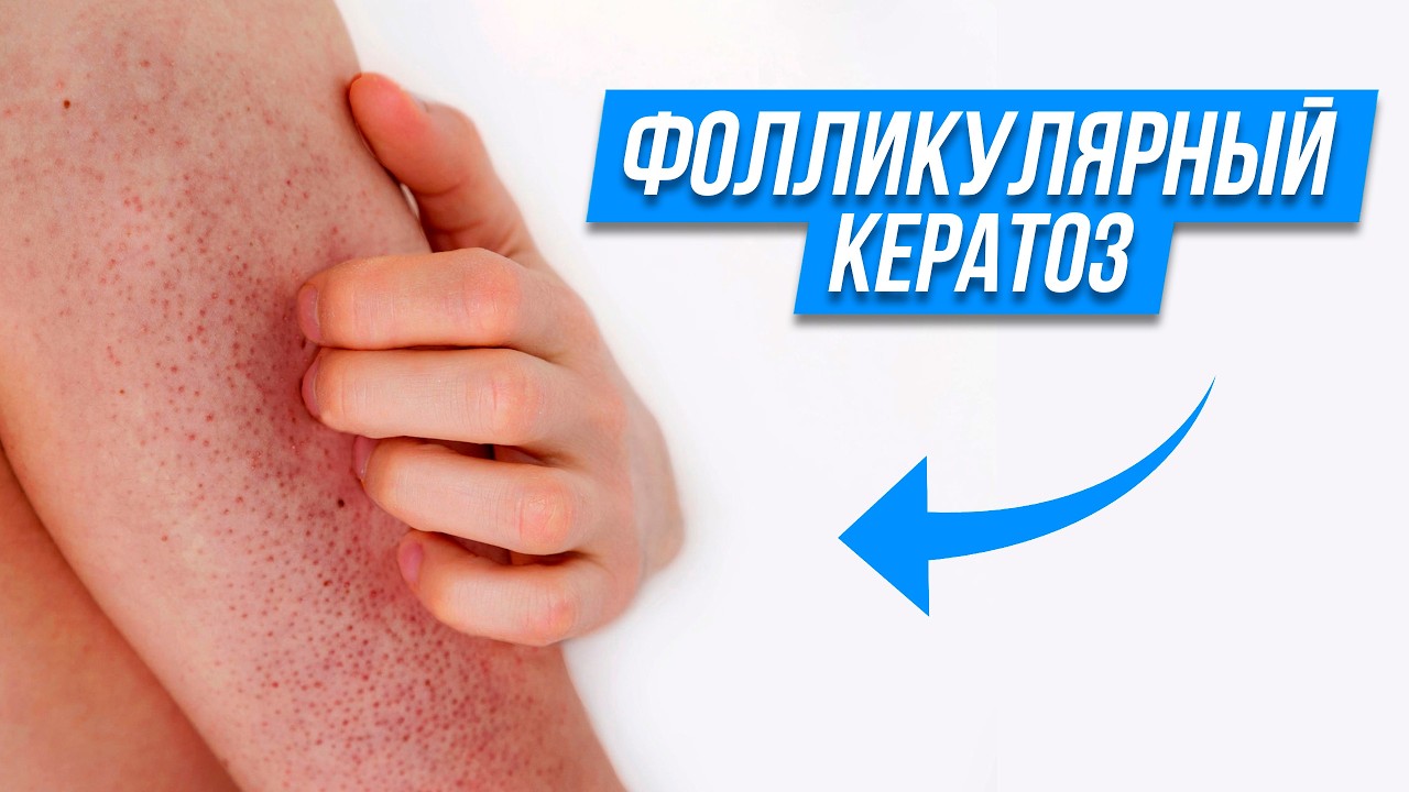 Вы ЗАБУДЕТЕ про ГУСИНУЮ КОЖУ! / Как ИЗБАВИТЬСЯ от фолликулярного гиперкератоза?