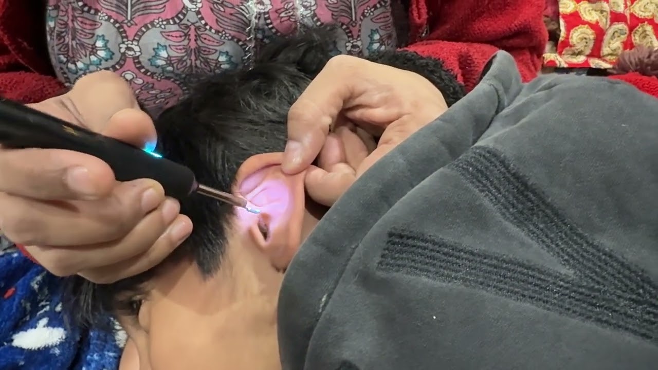 ASMR Deep🤯😱😱 Hard Ear Cleaning and Intense REMOVAL WITH Hard Chemical oil | #asmr