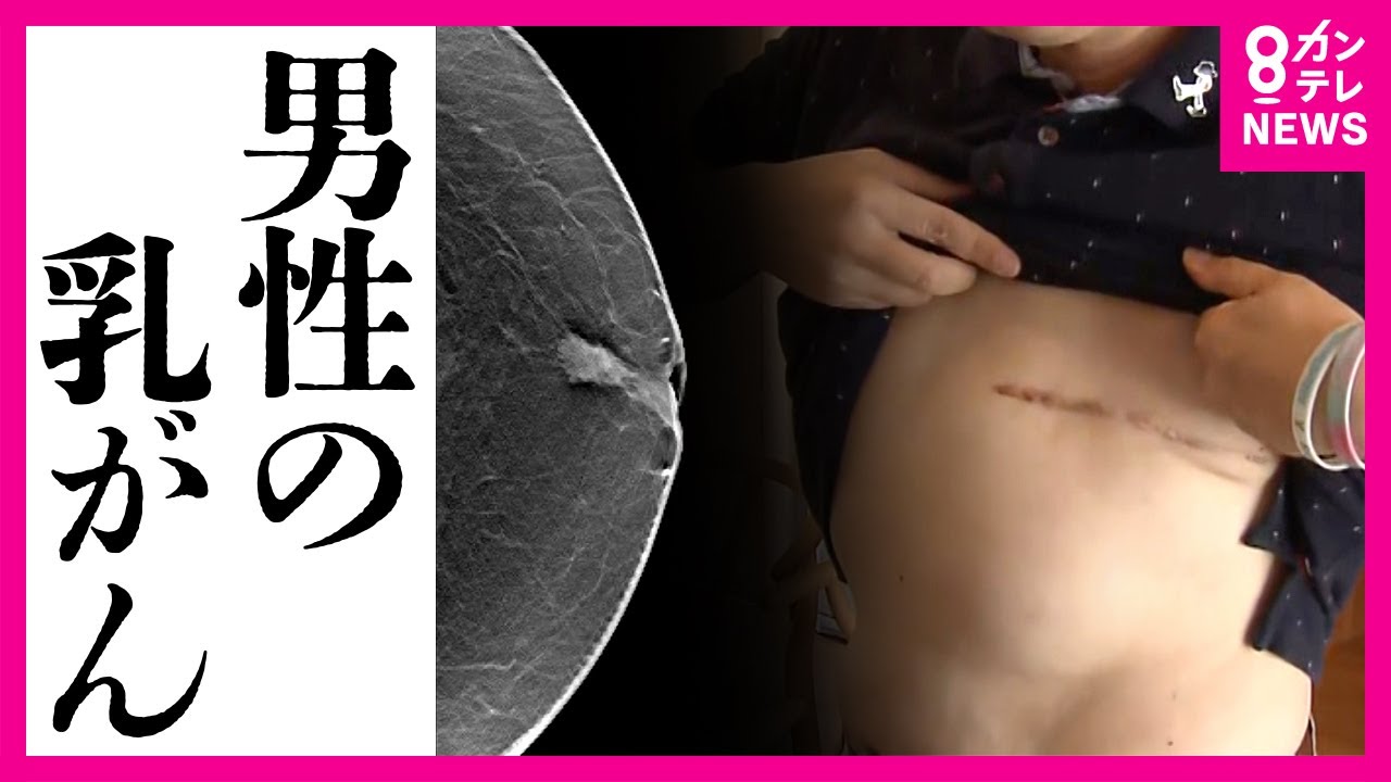 【男性も発症する“乳がん”】「左胸に窪みが…」 左乳房と左腕のリンパを切除　“認知度”が低く進行も早い男性の乳がん　年間100人以上が死亡　男性は「乳がん検診」の対象外　専門家解説〈カンテレNEWS〉