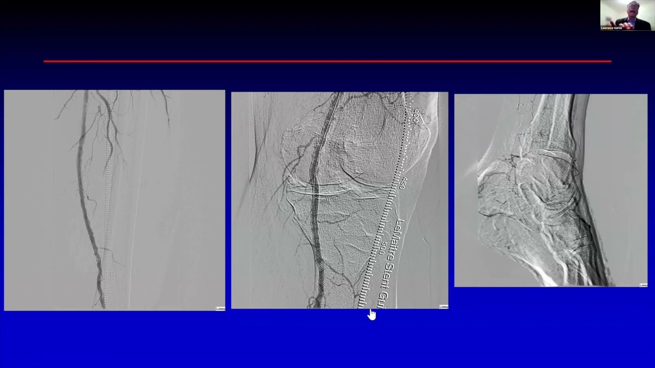 Atherectomy and Calcium Ablative Therapies