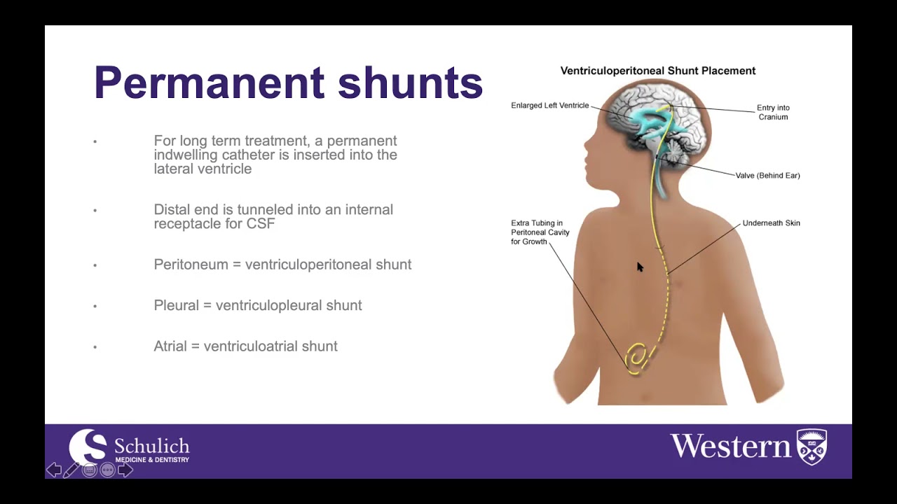 Anesthesia for CSF shunting procedures