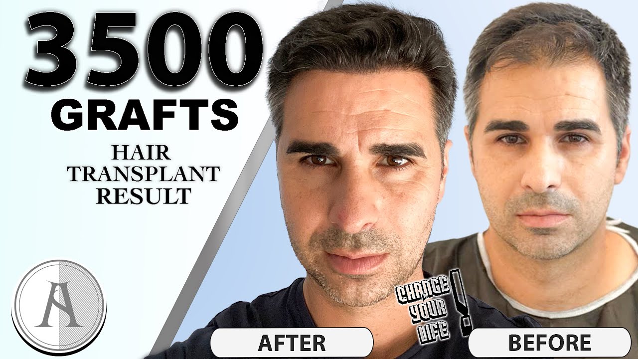 Most Natural Hair Transplant in Turkey |3500 GRAFTS| Injerto Capilar Más Natural en Turquía | AISHA