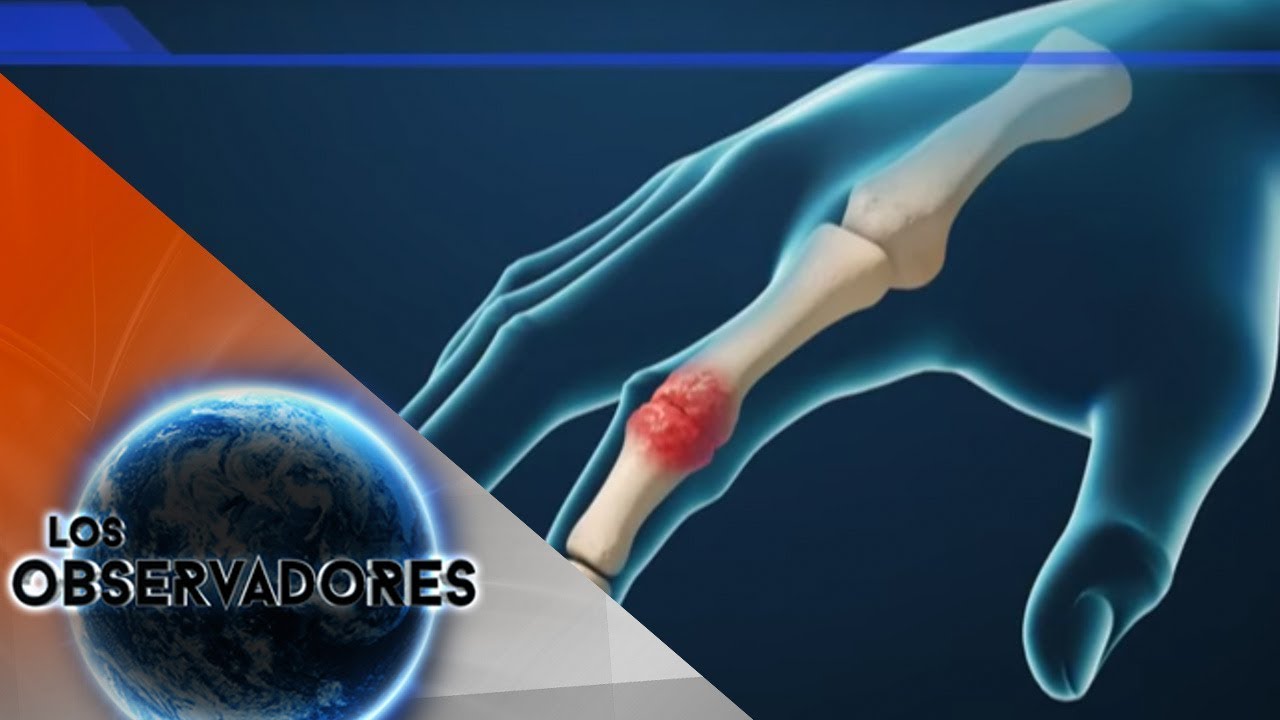 ENEMIGO SILENCIOSO: ARTRITIS REUMATOIDE PARTE II
