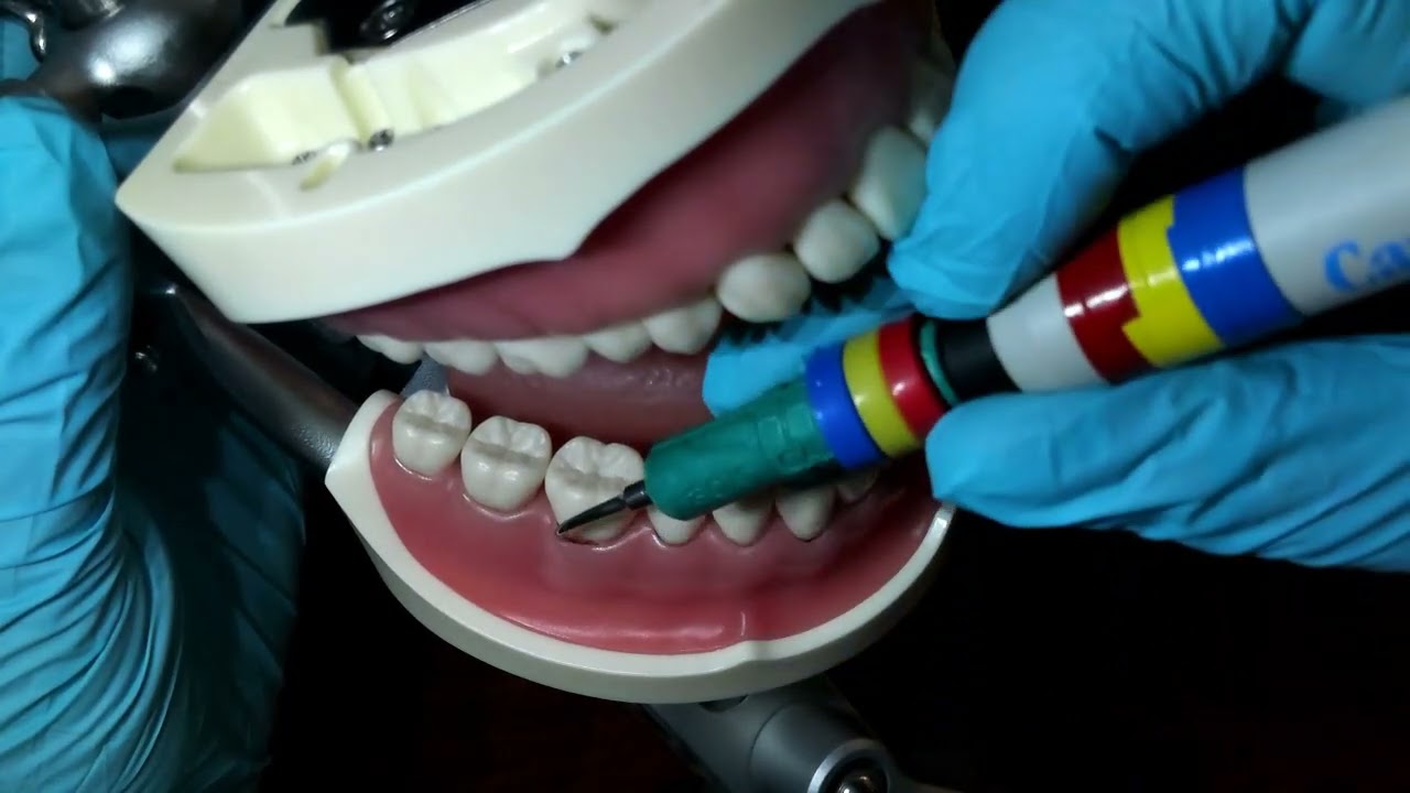 Ultrasonic scaler tooth #30 Buccal