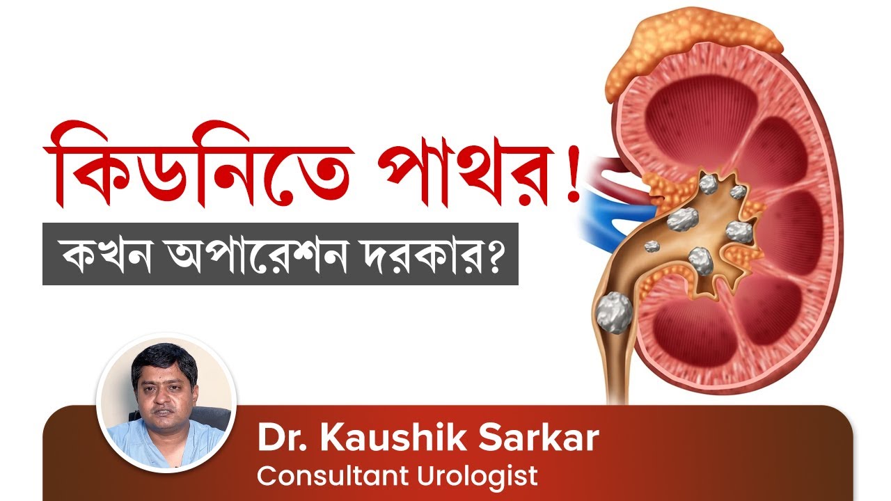 কিডনিতে পাথর হলে কি করণীয়? কখন অপারেশন দরকার | Treatment of Kidney Stone | When Surgery is needed