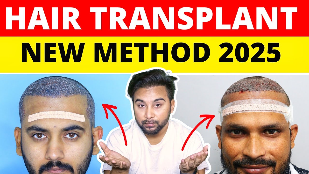 FUE Vs. Interlocking Vs. Derma Technique : Hair Transplant Result Comparison 🔥🔥🔥