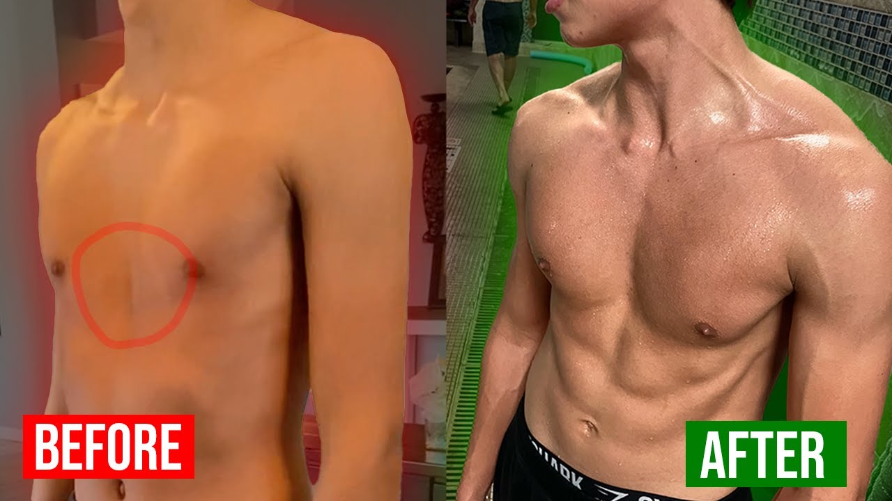 The Best Pectus Excavatum Transformation of 2024 (NO SURGERY!)