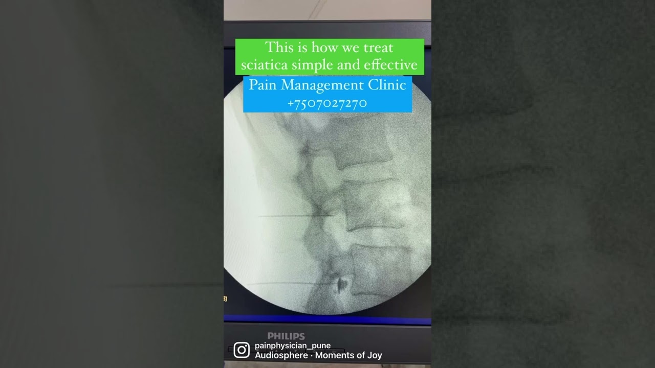 Sciatica -treatment without surgery for selected cases