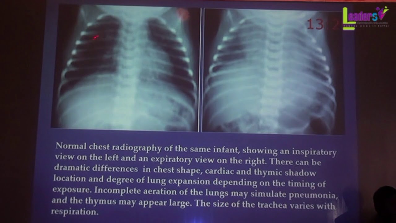 Value of chest X-rays in ventilated neonates   Prof. Hisham Awad