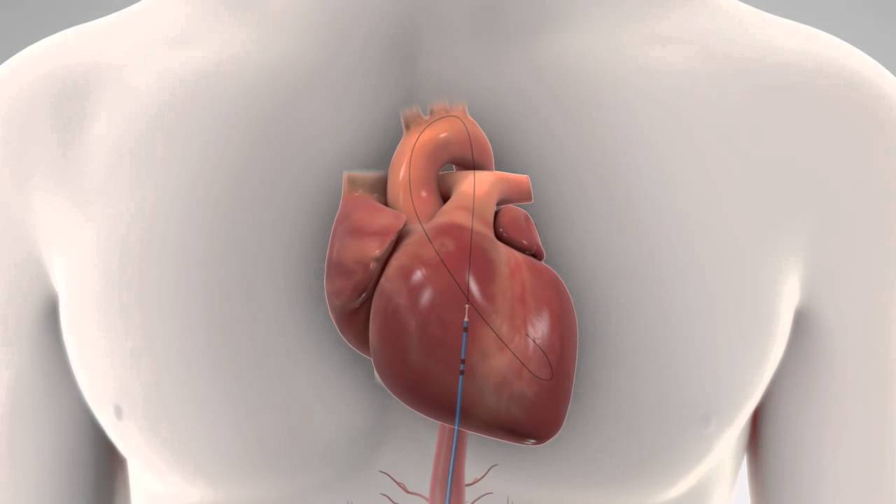 Thoratec Percutaneous Heart Pump