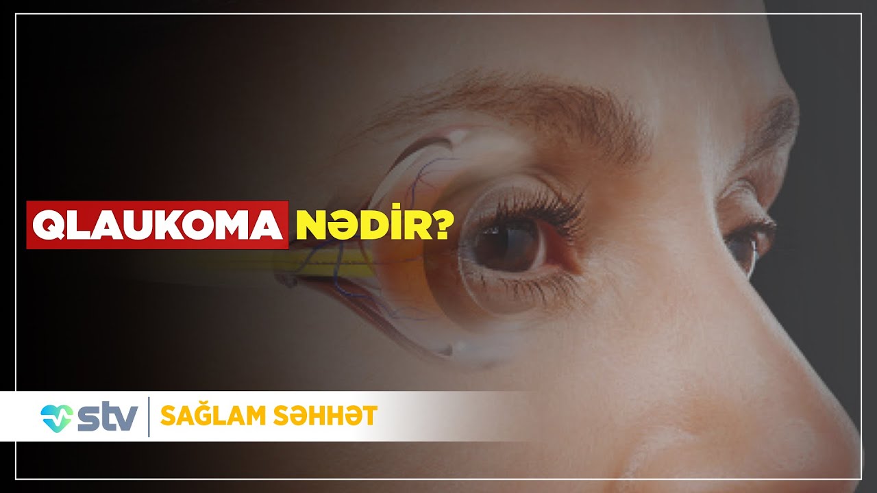 Qlaukoma nə xəstəliyidir? - (09.10.2025)