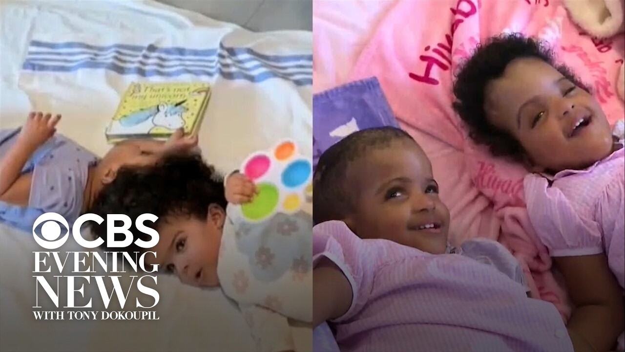Doctors successfully separate twin girls conjoined at the head