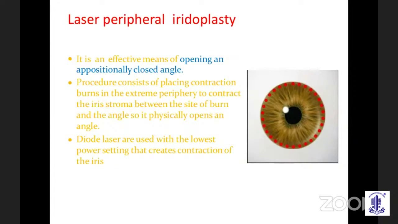 PG Update Series on Glaucoma-Lasers in Glaucoma-Dr.Chandrima Paul