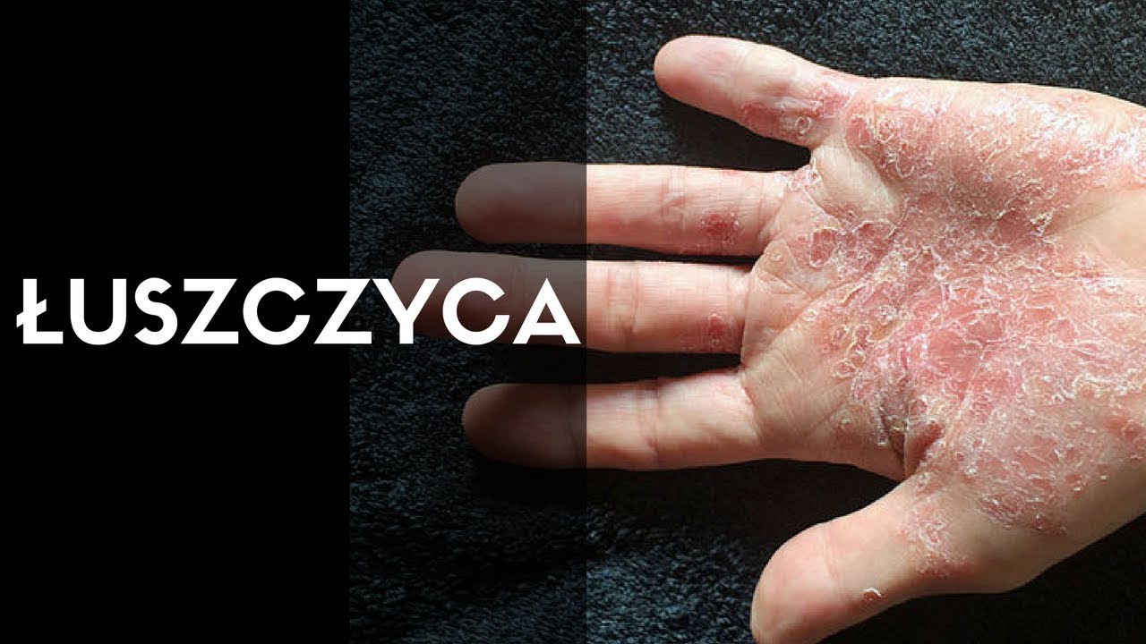 Dermatolog mówi o: ŁUSZCZYCA