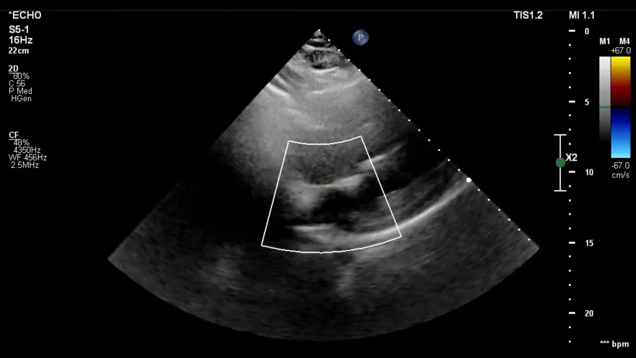 [Echo Case Review] R/O ASD 심방중격결손 의심