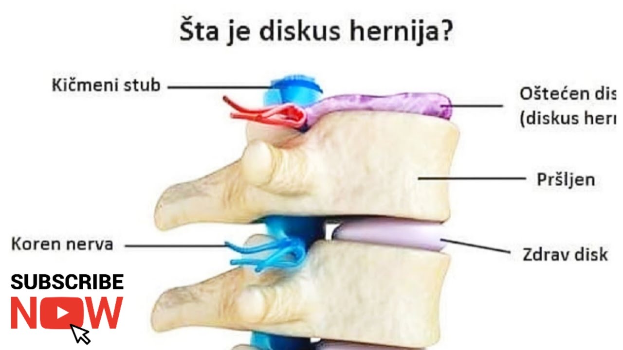 DISKUS-HERNIJA-lecenje bez operacije-zivot bez bola. DISCUS HERNIATION - treatment without surgery!