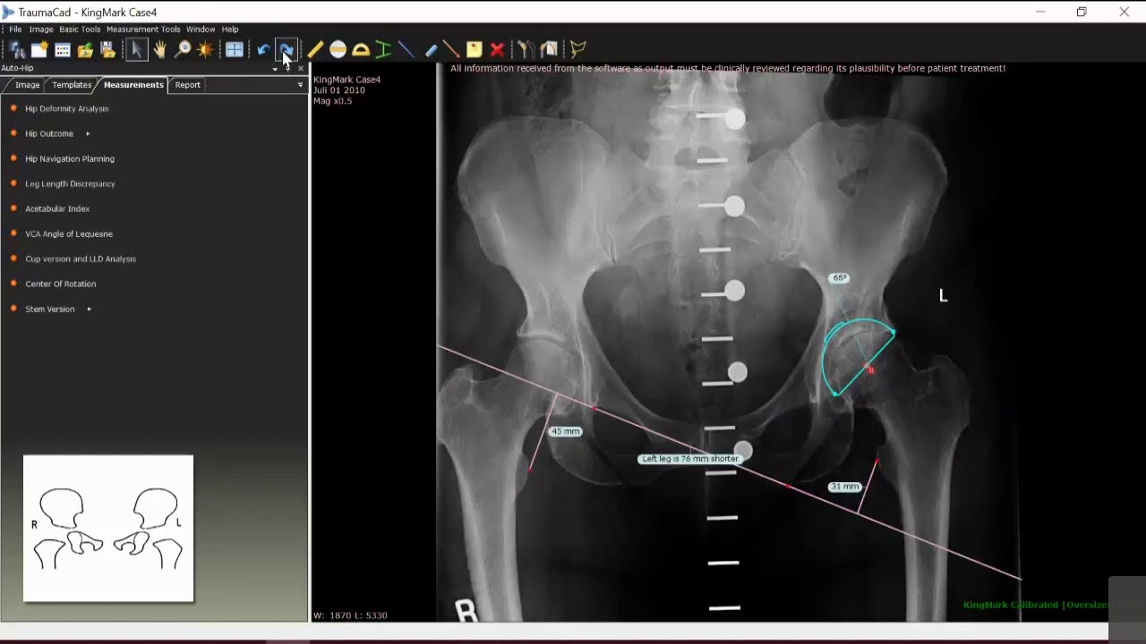 Getting started with TraumaCad Webinar