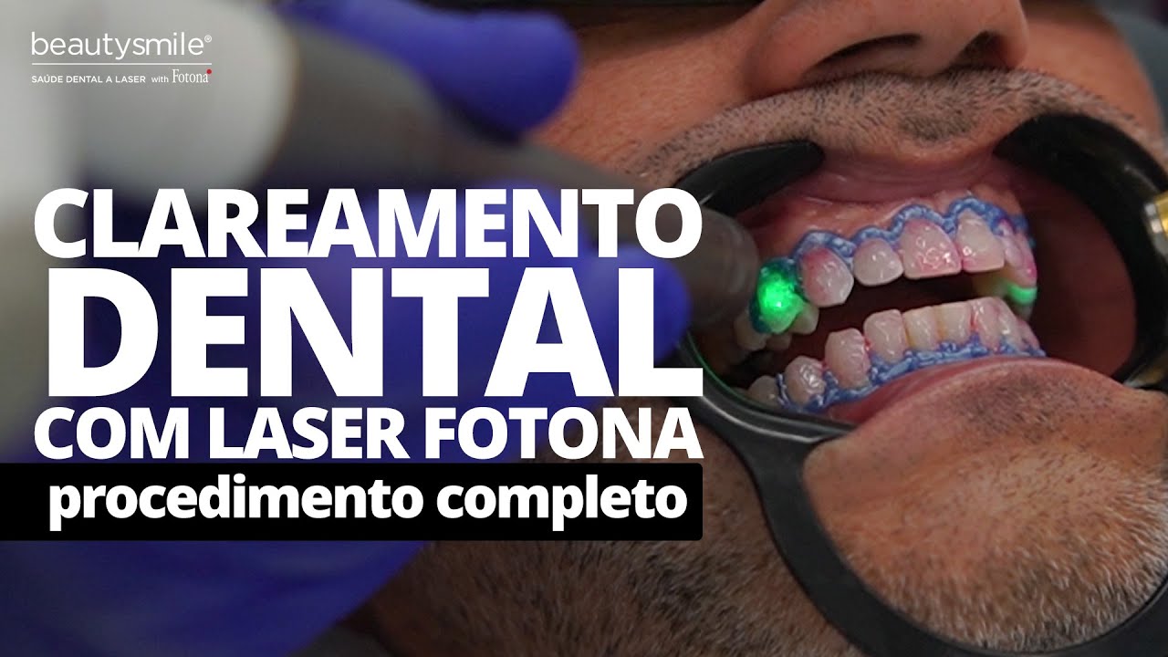 Clareamento dental com laser na prática!