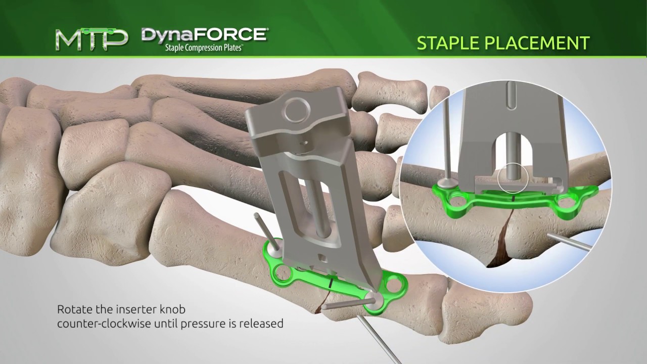 DynaForce Staple Compression Plates(SCP) for MTP Fusions