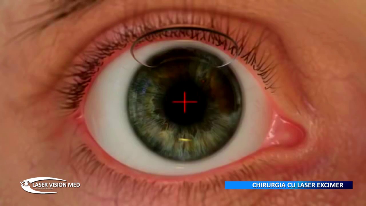 Operatia cu LASER EXCIMER, prezinta dr. Ioan Stefaniu