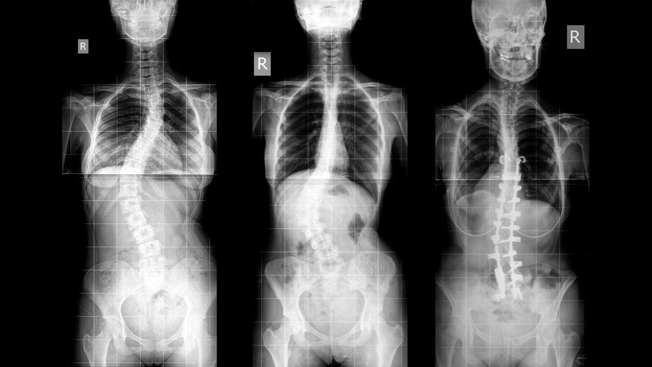 Scolioza idiopatică adolescentină: diagnostic corect, evaluare clinică și ce contează cu adevă