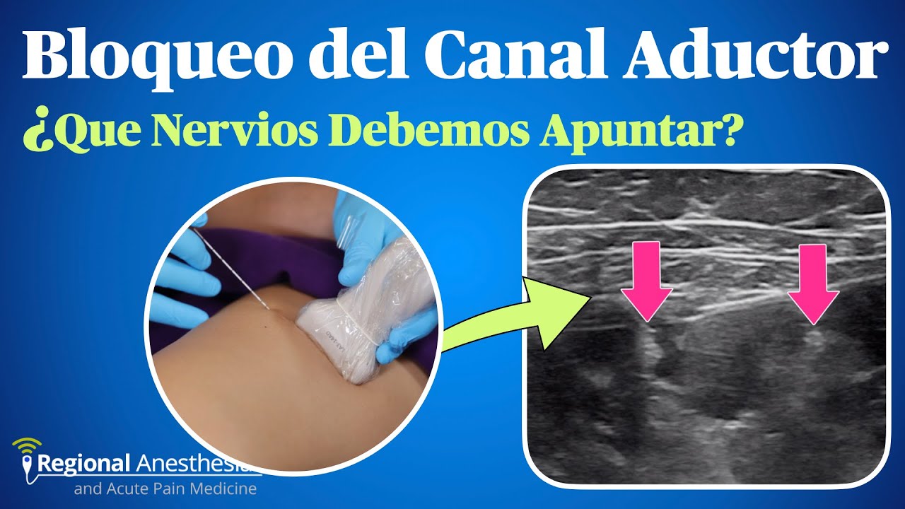 Bloqueo del Canal Aductor: ¿Que Nervios Debemos Apuntar?