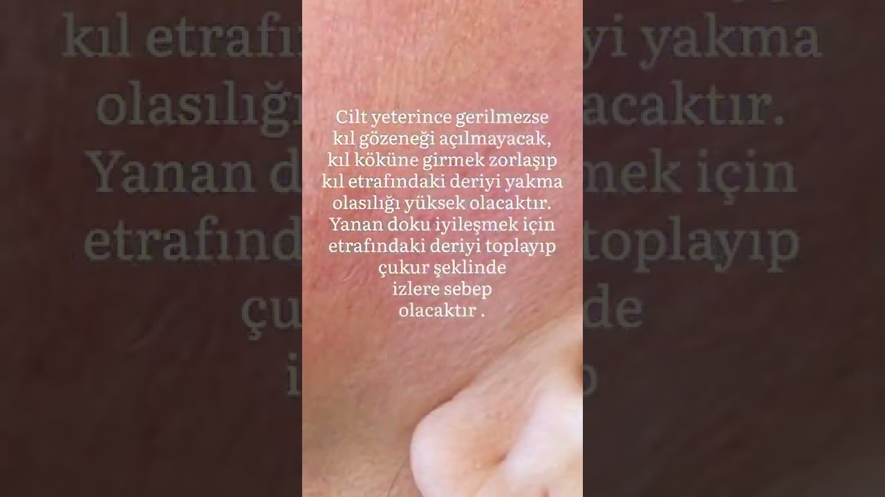 #iğneliepilasyoneğitimi#shorts#keşfet#iğneliepilasyon