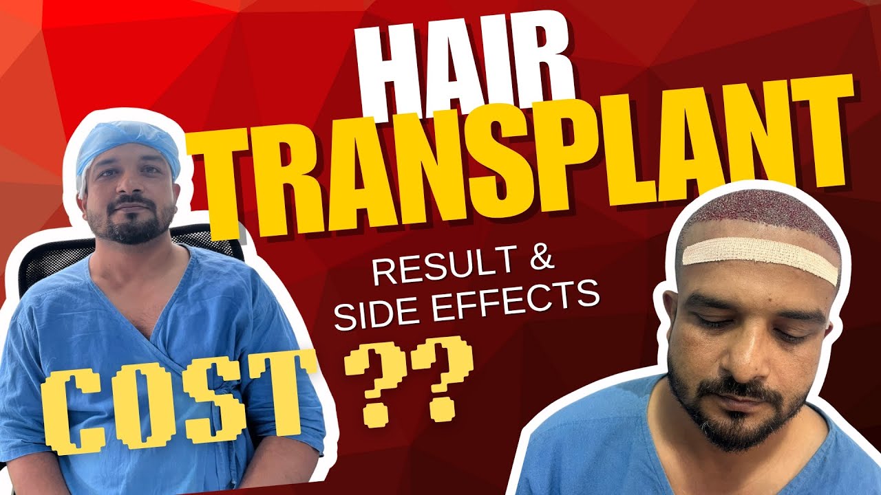 Hair Transplant Result | Cost Kitni aayi | Best Clinic for Hair transplant