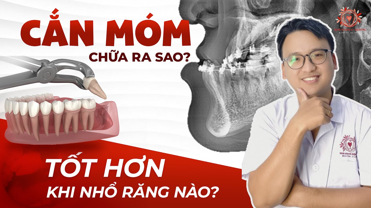 Phương Pháp Mới Điều Trị Khớp Cắn Ngược: Nên Nhổ Răng Khôn Hay Răng Cối Tốt Hơn?| Nha khoa Sdental