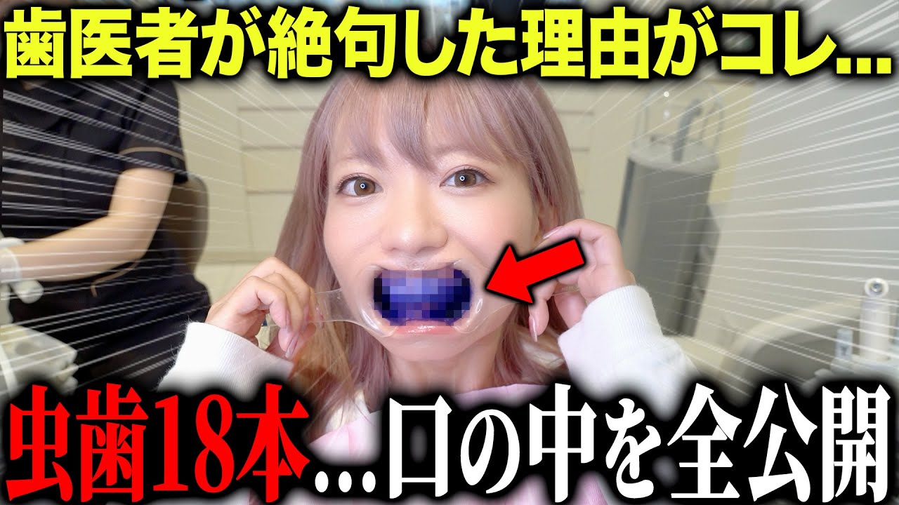 虫歯18本の美女の口の中を大公開&hellip;歯医者も驚愕したその理由がこちら。