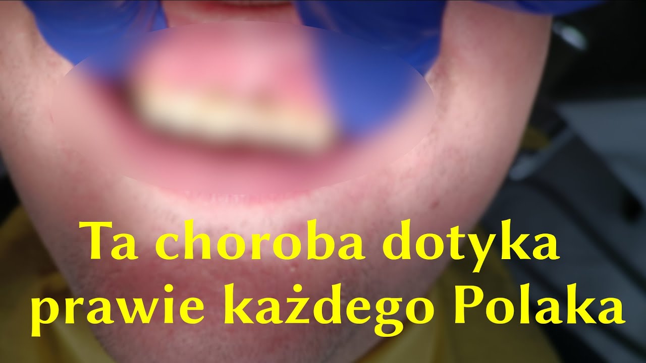 Próchnica - wszystko co powinien wiedzieć pacjent