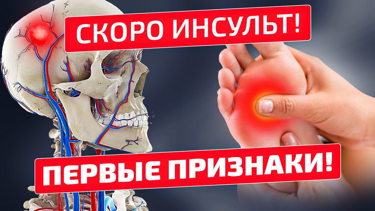 99% инсультов были после этих признаков! Инсульт головного мозга