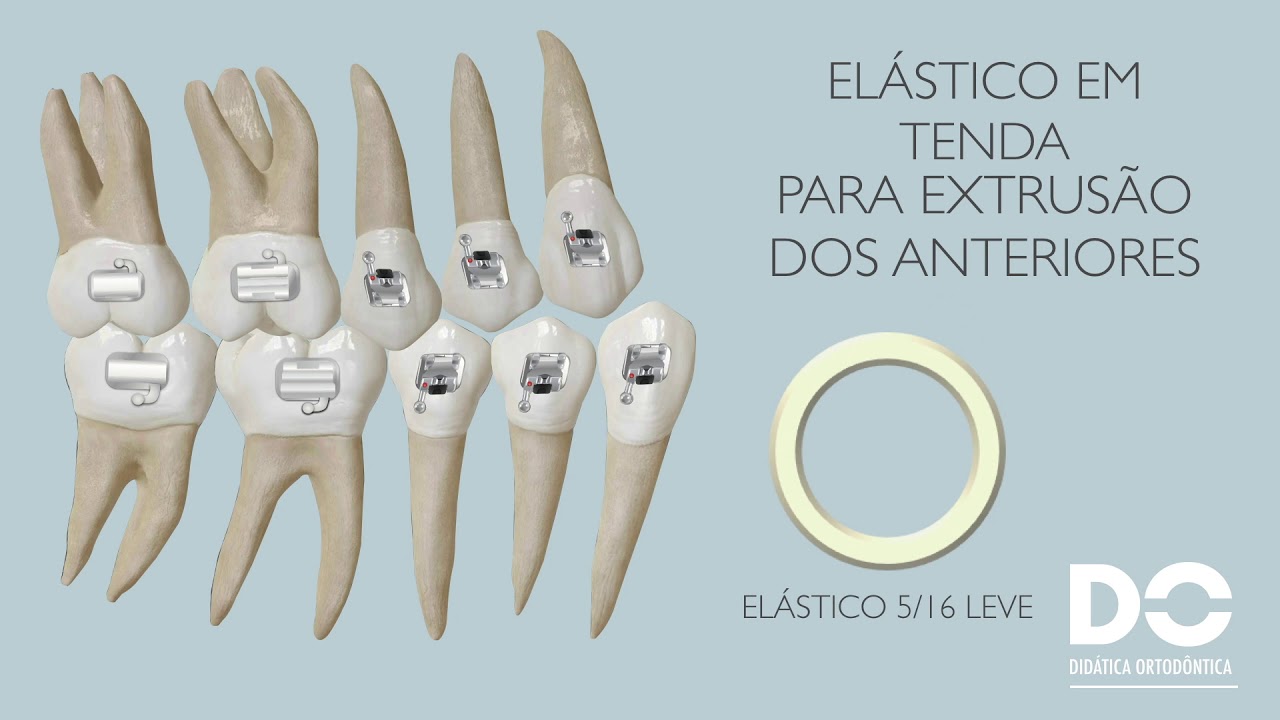 USO PRECOCE DE ELÁSTICOS EM AUTOLIGADO