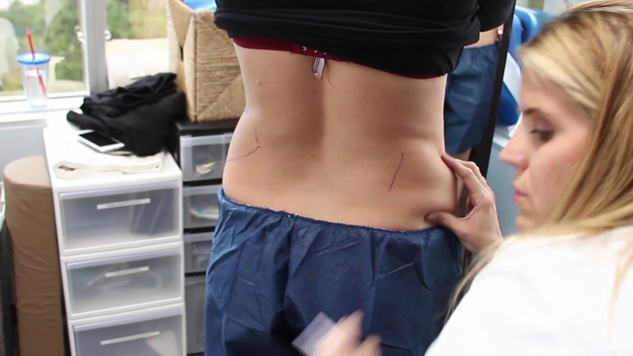 Coolsculpting Treatment for Fat Removal