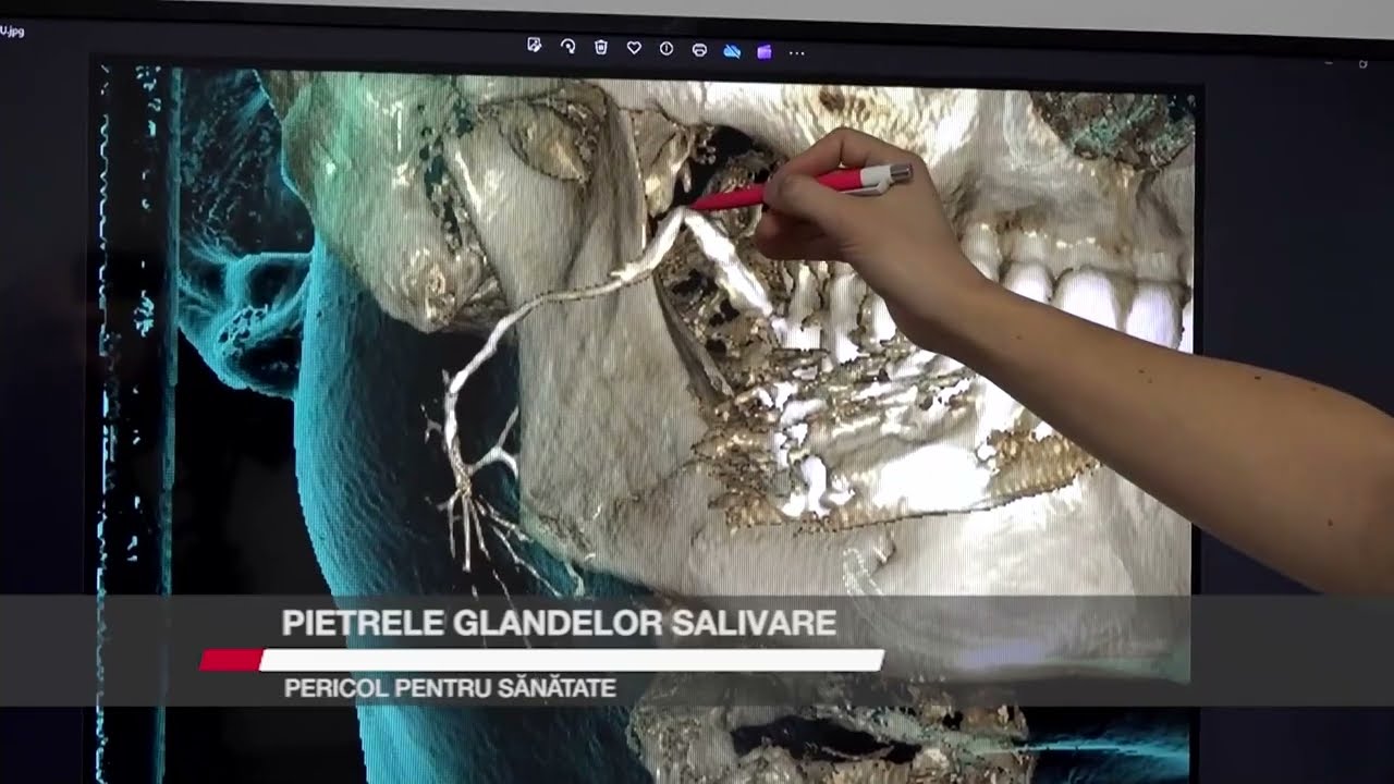 Pietrele glandelor salivare, pericol pentru sănătate