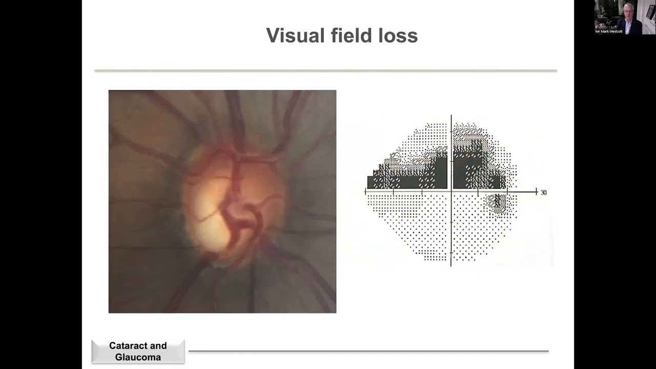 Glaucoma support group: Glaucoma and cataracts