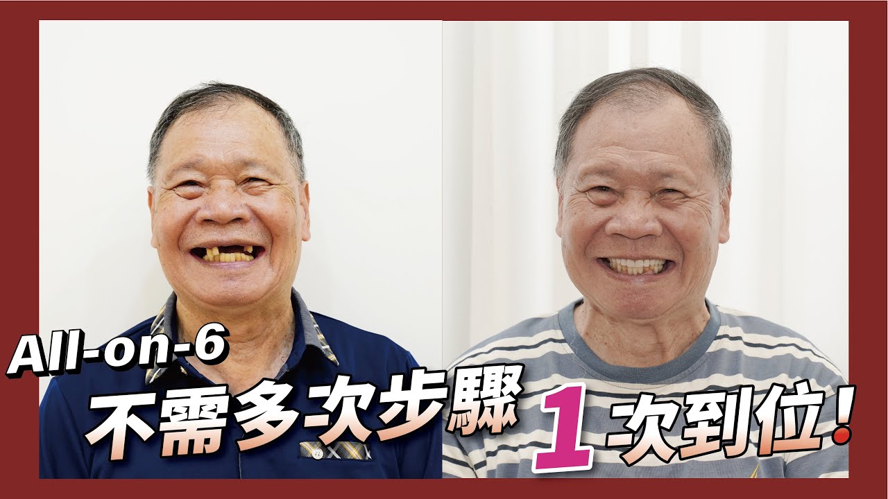 All-on-6 快速全口重建 | 康智為醫師真實案例解析