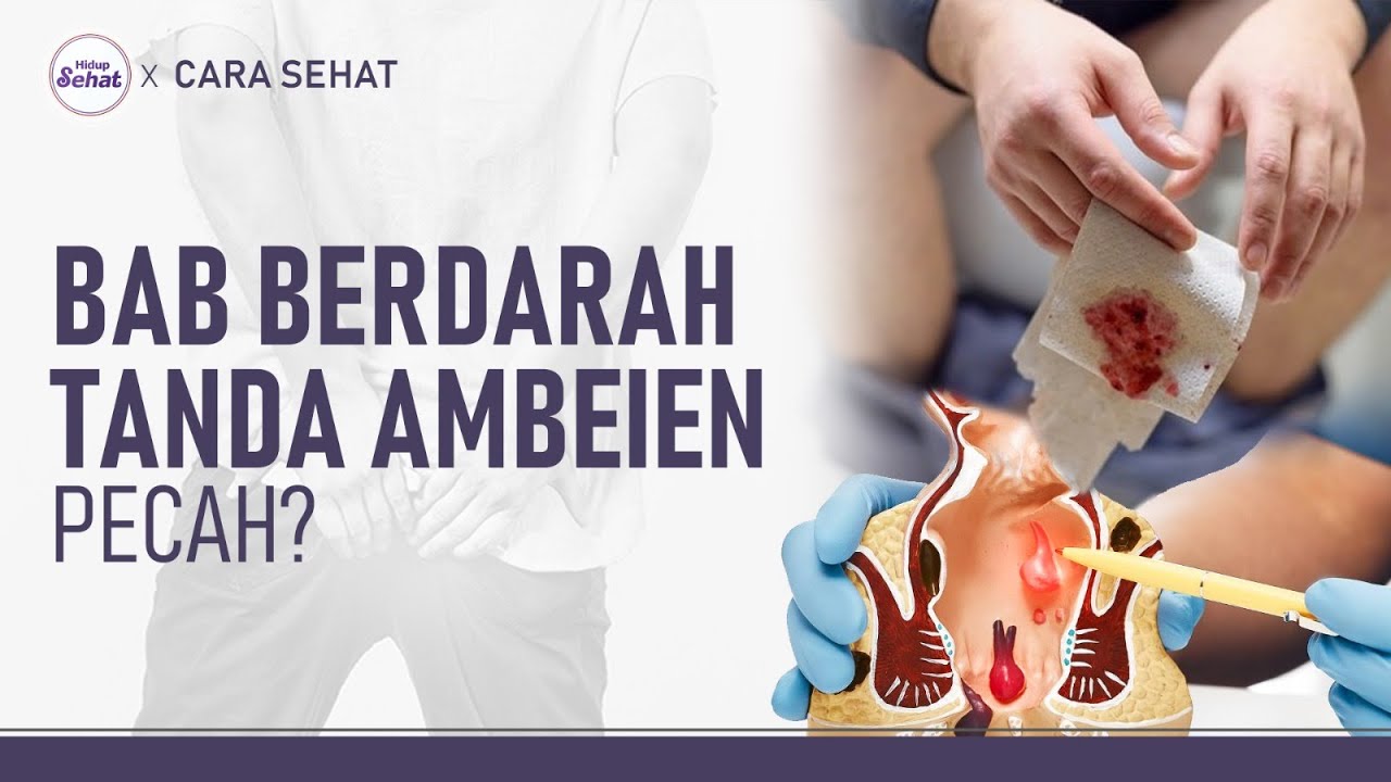 Awas, Ambeien Pecah! Ini Tips Alami Mencegah dan Mengatasi Wasir | Hidup Sehat tvOne