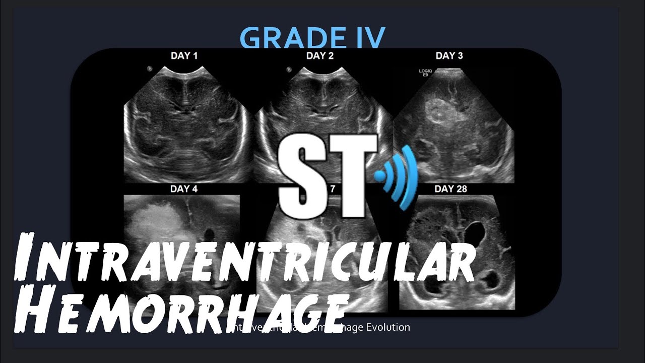 Intraventricular Hemorrhage (Neonatal IVH/Brain Bleed)