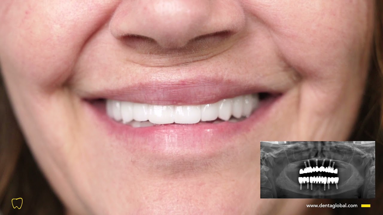 Look how good these implant-supported zirconium crowns look! 🤩