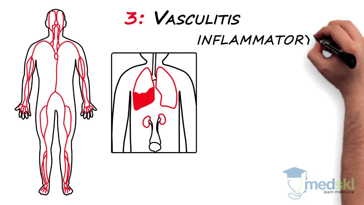 Rheumatology – Polyarticular Pain: By Lori Albert M.D.
