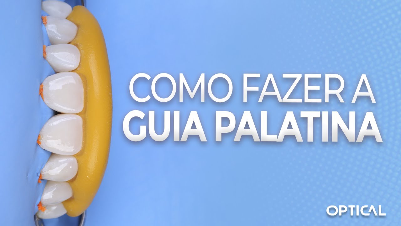 Como fazer a guia palatina com silicone de adição