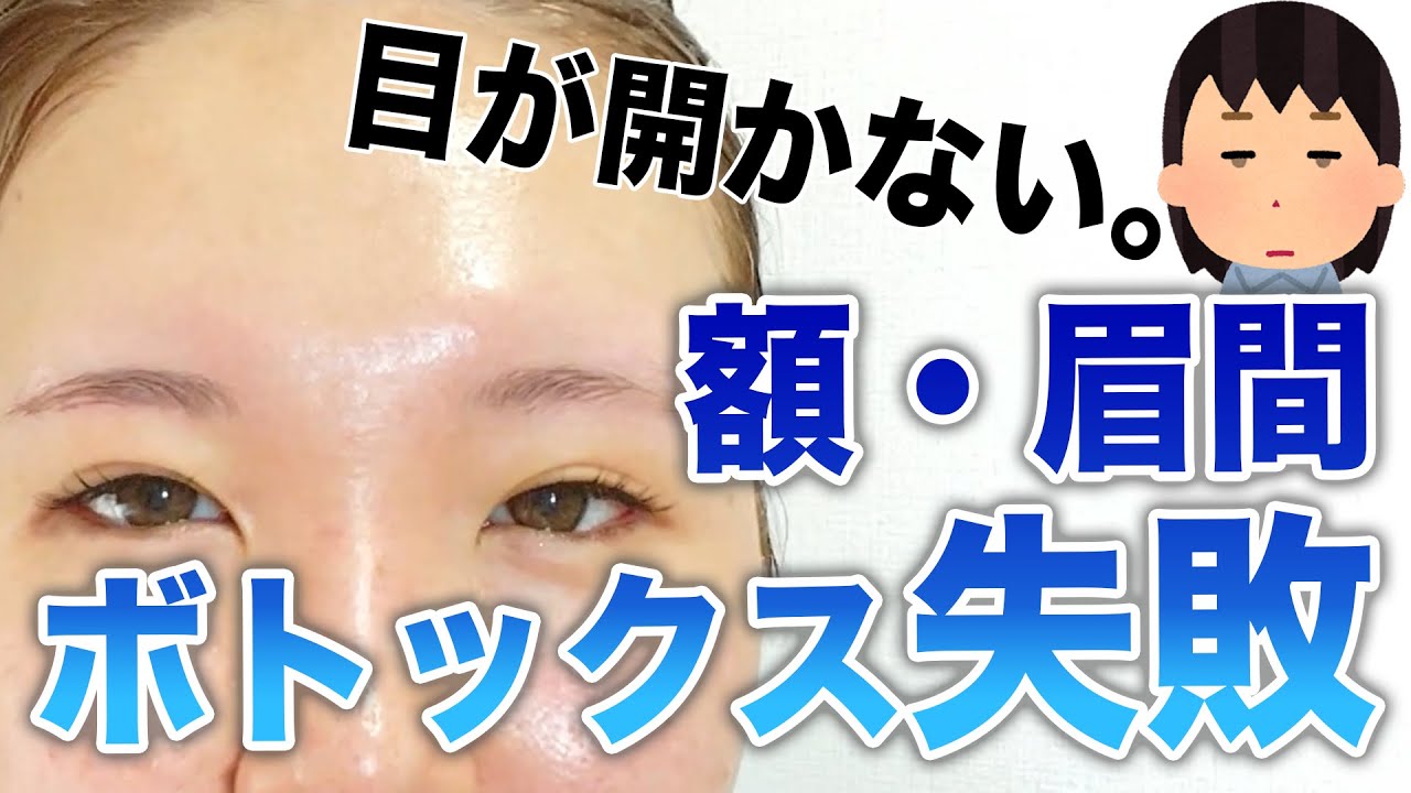 【ボトックスも失敗した】眉毛上げる族へ伝えたい想い←【額・眉間】