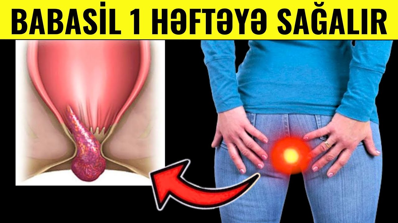 Babasili Belə Müalicə Edin - Evdə 1 Həftəyə Sağalacaq!