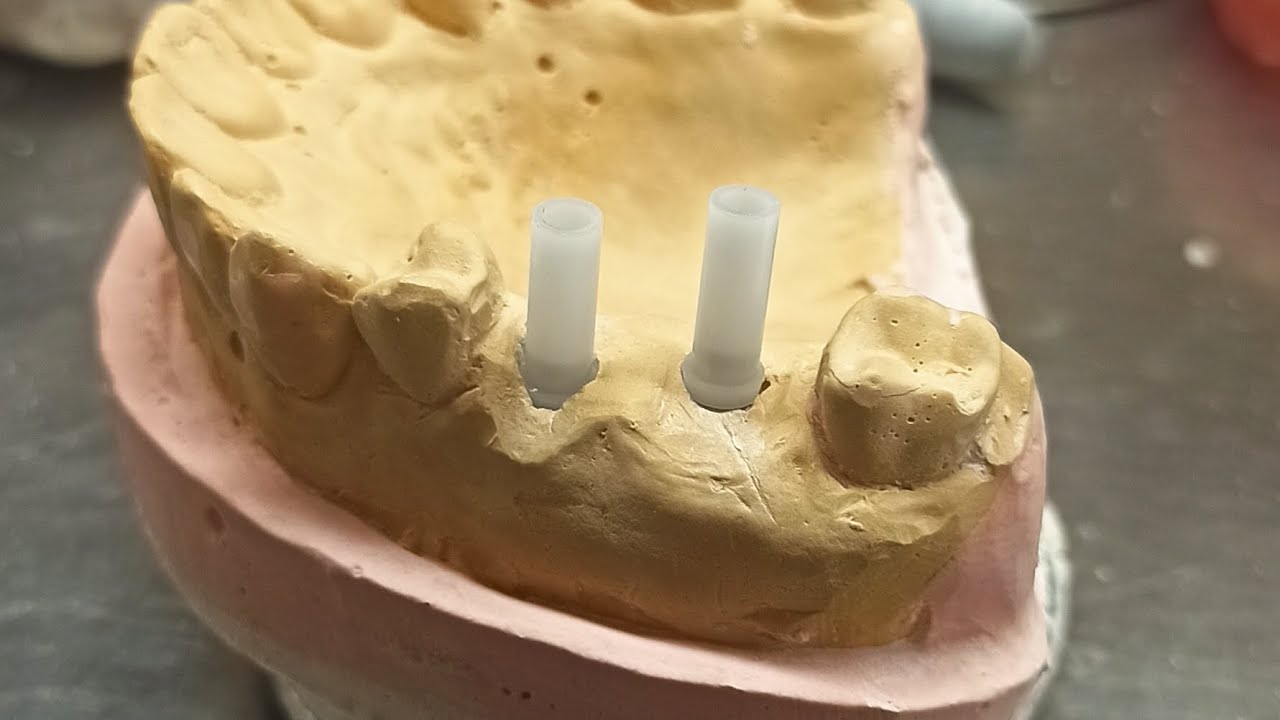 Puente y corona sobre implantes en metal-cerámica